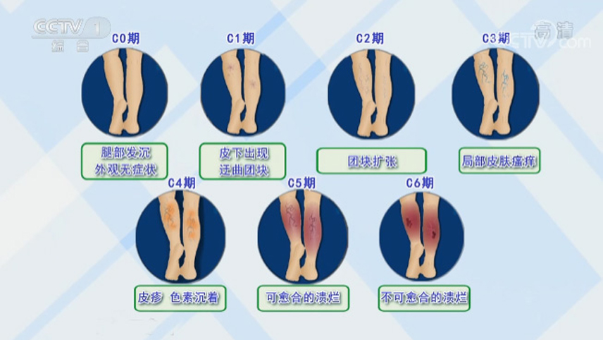 别让“蚯蚓”爬上你的腿