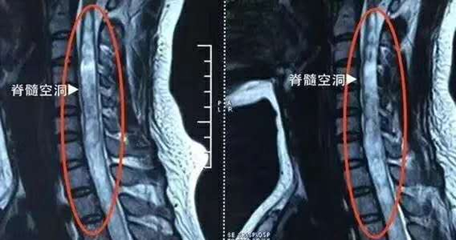 人造脊髓植入物有望使瘫痪者恢复行走