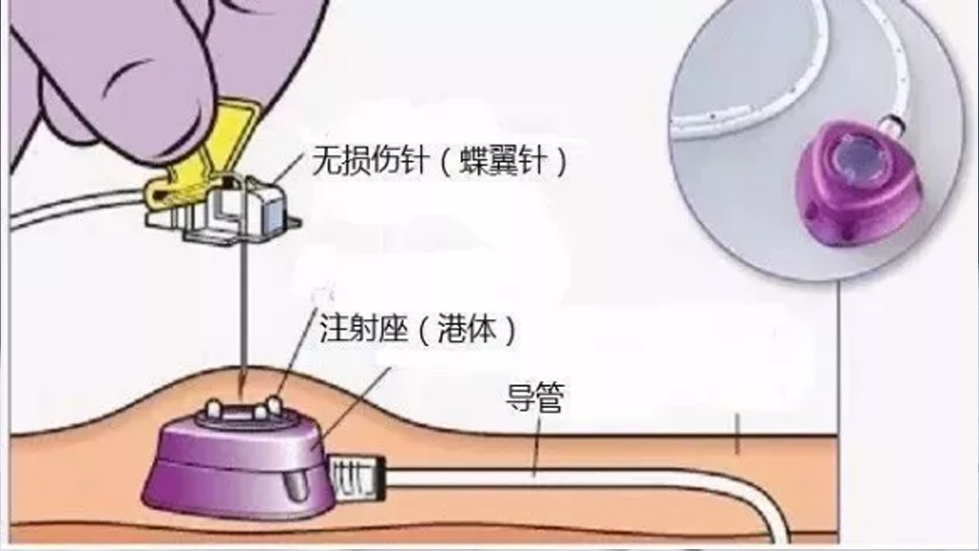 多学科协作破高龄治疗难题，输液港技术启精准医疗新篇--太原市第七人民医院