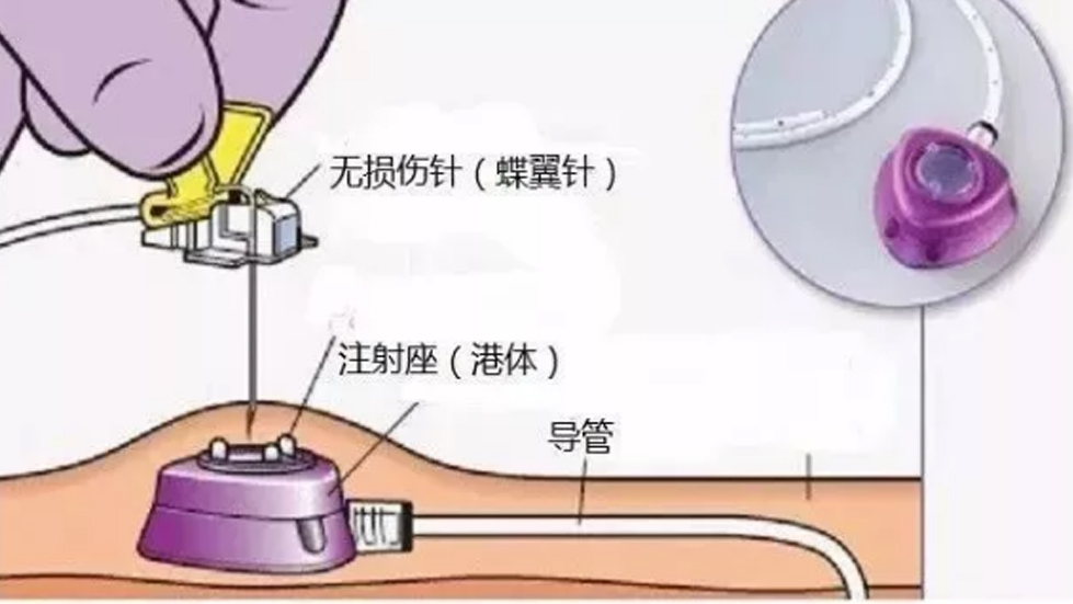 多学科协作破高龄治疗难题，输液港技术启精准医疗新篇--太原市第七人民医院以创新实践守护患者健康